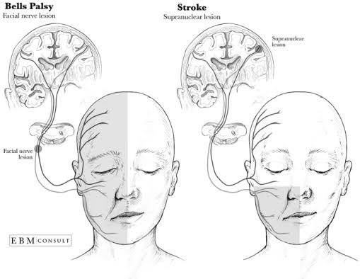 Bell's Palsy or stroke